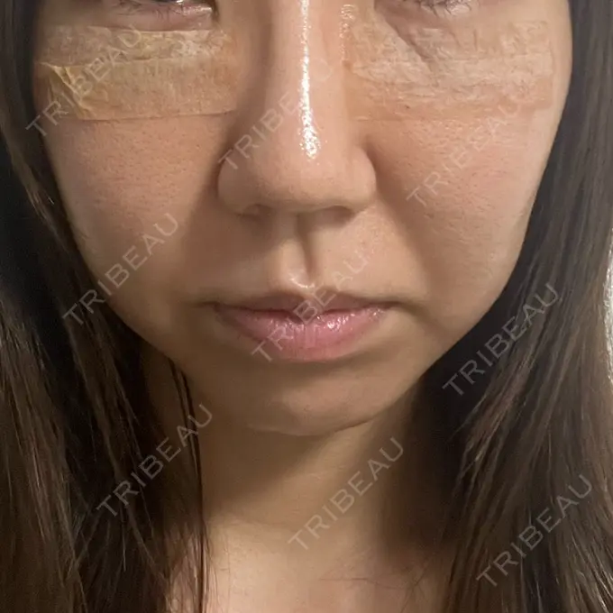 クマ治療 吉井クリニック DAY 3 メイン用