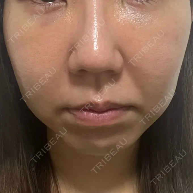 クマ治療 吉井クリニック DAY 4 メイン用