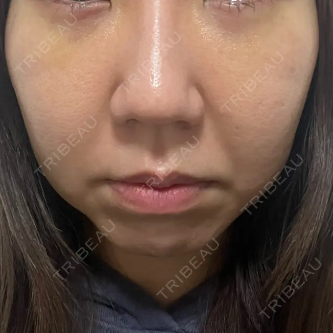 クマ治療 吉井クリニック DAY 5 メイン用