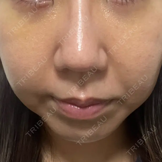 クマ治療 吉井クリニック DAY 6 メイン用