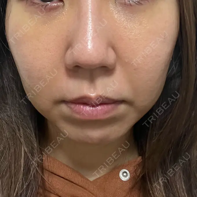 クマ治療 吉井クリニック DAY 7 メイン用