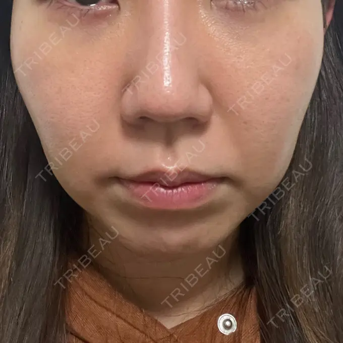 クマ治療 吉井クリニック DAY 8 メイン用