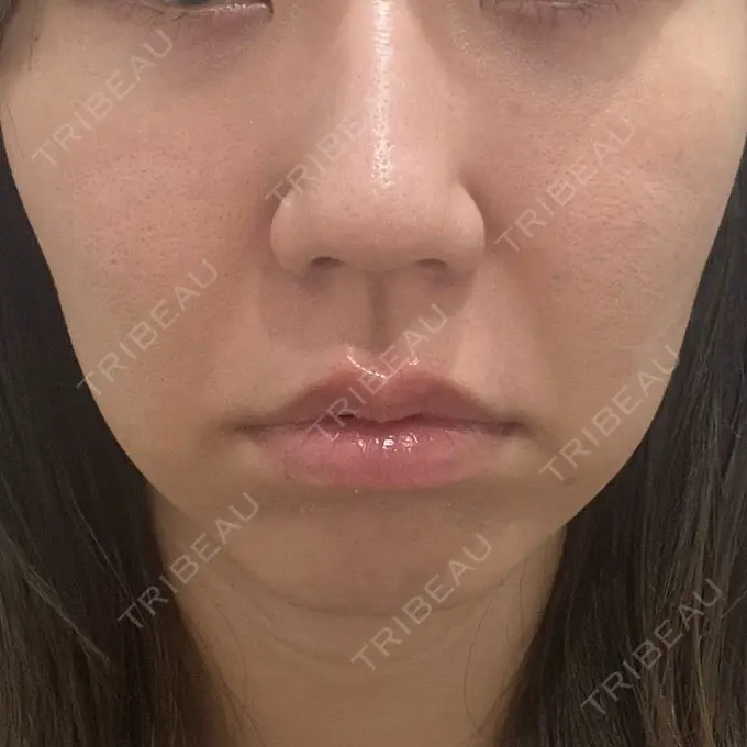 クマ治療 吉井クリニック DAY 41 メイン用