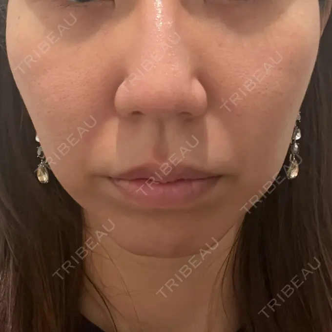 クマ治療 吉井クリニック AFTER メイン用