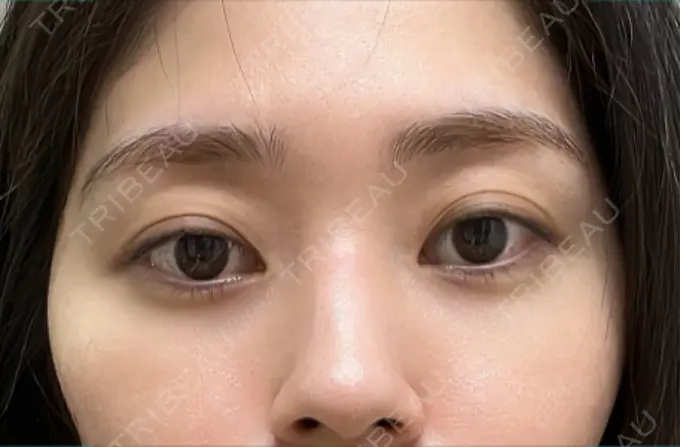 クマ治療 / 脂肪注入（目の下） 吉井クリニック AFTER メイン用