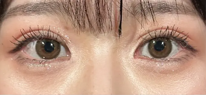 二重埋没 THE FIRST CLINIC 多摩センター院 DAY 8 メイン用