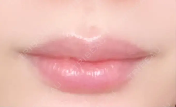 ヒアルロン酸注入（唇） / ボトックス（口角） L‘amour clinic Tokyo【ラムールクリニック東京】 AFTER メイン用