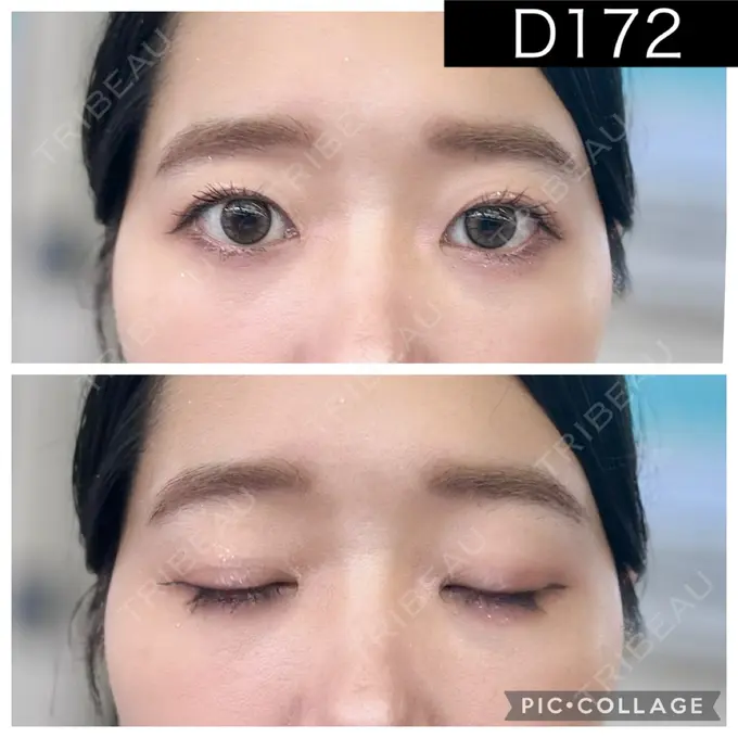 二重埋没 湘南美容クリニック 町田院 DAY 172 メイン用