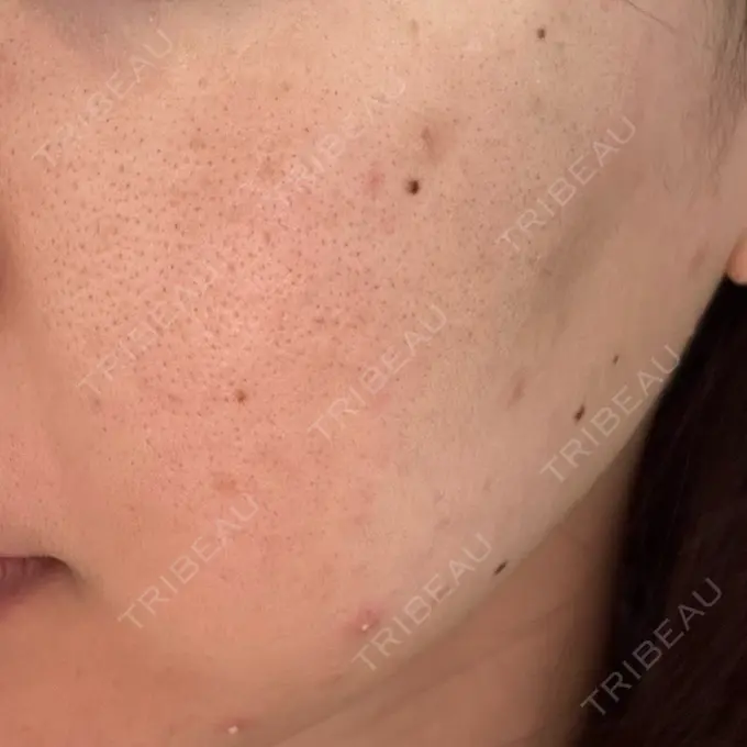 美肌レーザー / シミ取りレーザー / フラクショナルレーザー（毛穴・ニキビ跡） / YAGレーザー / 赤み除去レーザー / ピコフラクショナルレーザー（毛穴・ニキビ跡） AI Beauty Clinic （エーアイ美容クリニック） DAY 0 メイン用