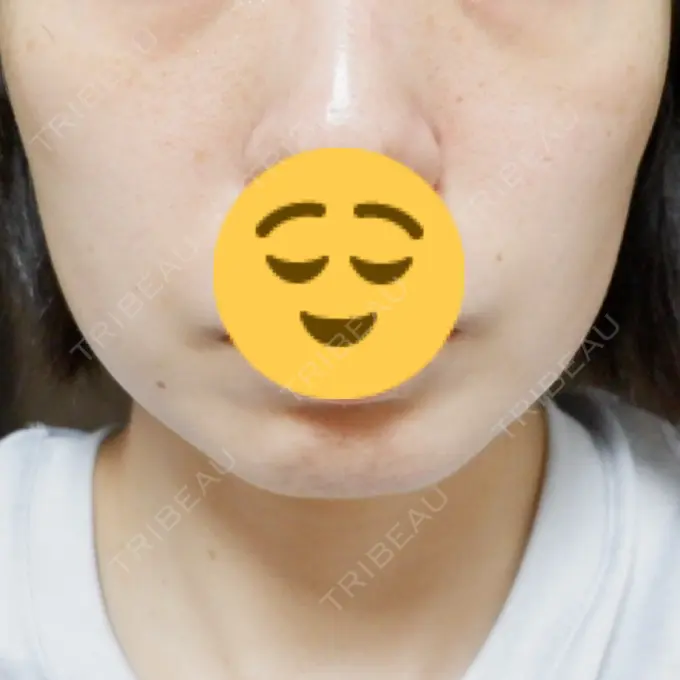 ボトックス（エラ・小顔） TCB東京中央美容外科 つくば院 DAY 1 メイン用