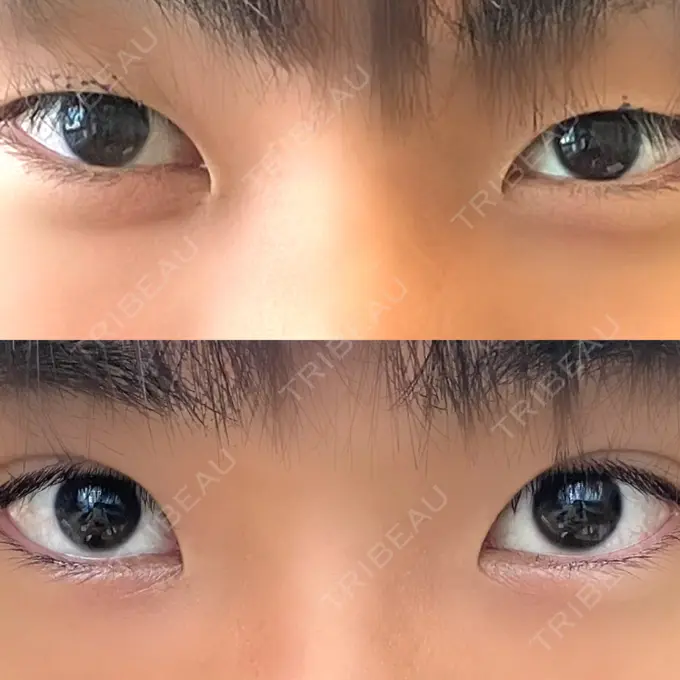 二重埋没 日本ウェルネス再生クリニック DAY 0 メイン用