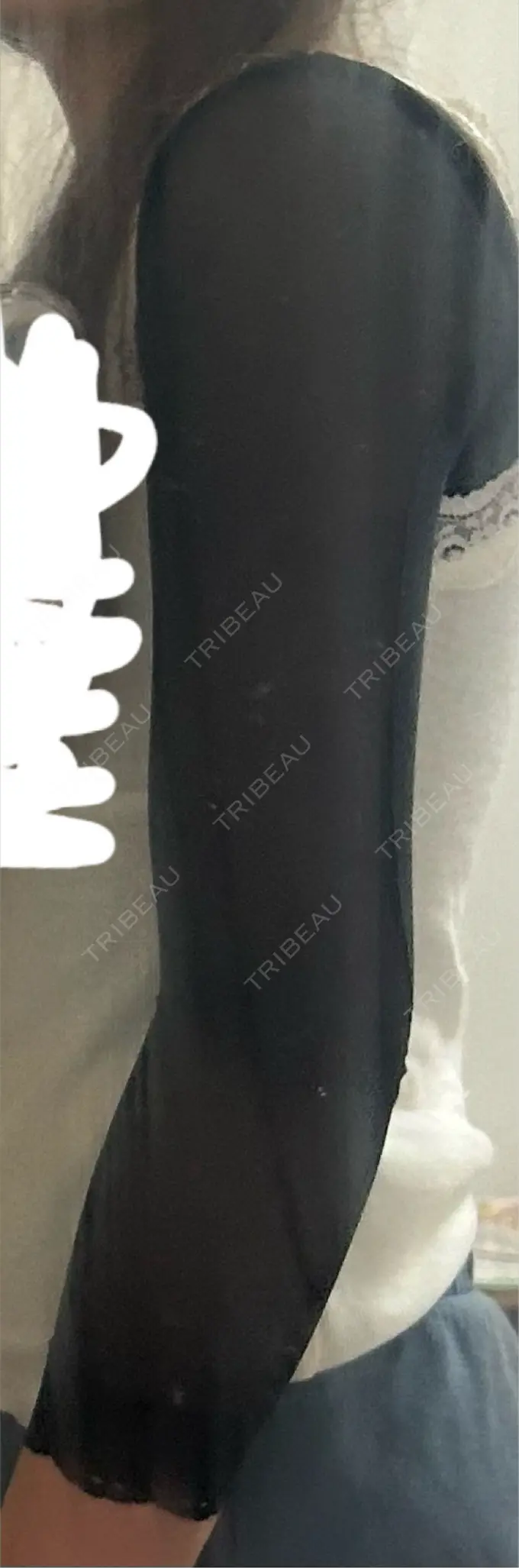 脂肪吸引（二の腕） / 脂肪吸引（肩） / その他（ボディ） ルーチェクリニック 銀座院 DAY 2 メイン用