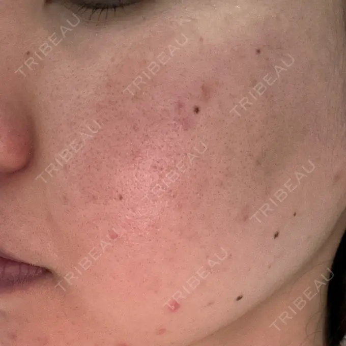 美肌レーザー / シミ取りレーザー / フラクショナルレーザー（毛穴・ニキビ跡） / YAGレーザー / 赤み除去レーザー / ピコフラクショナルレーザー（毛穴・ニキビ跡） AI Beauty Clinic （エーアイ美容クリニック） DAY 1 メイン用