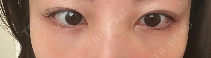 クマ治療 ROOTS Clinic DAY 4 メイン用