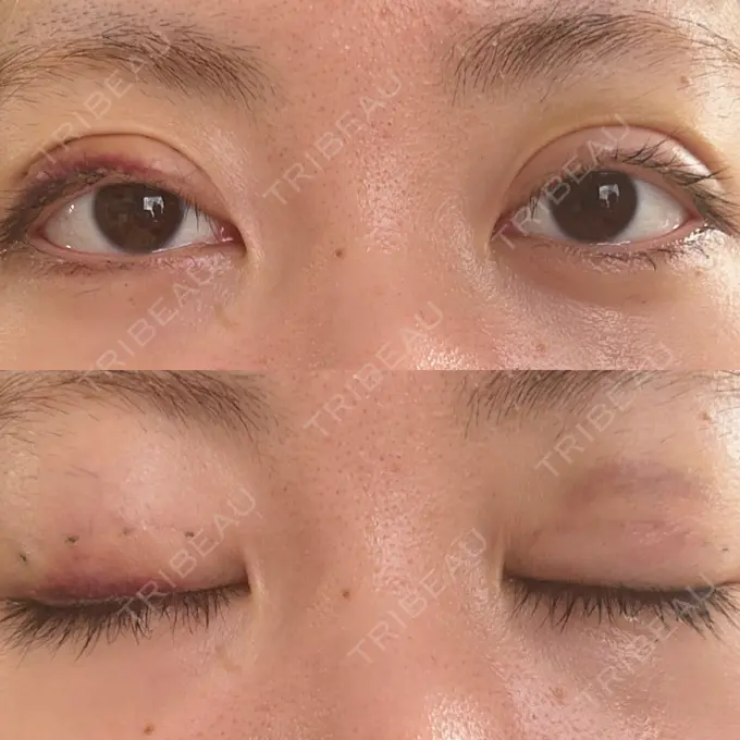 二重埋没 東京ココセランクリニック DAY 8 メイン用