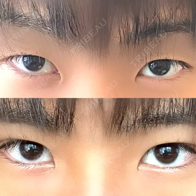 二重埋没 日本ウェルネス再生クリニック AFTER メイン用