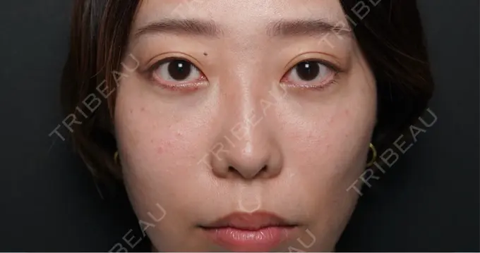 糸リフト / クマ治療 / 下まぶたの脂肪取り / ヒアルロン酸注入（頬） / ヒアルロン酸注入（目の下） / その他（目元） ROOTS Clinic AFTER メイン用