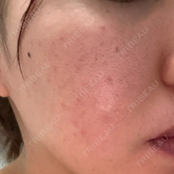 美肌レーザー / シミ取りレーザー / フラクショナルレーザー（毛穴・ニキビ跡） / YAGレーザー / 赤み除去レーザー / ピコフラクショナルレーザー（毛穴・ニキビ跡） AI Beauty Clinic （エーアイ美容クリニック） DAY 2 メイン用