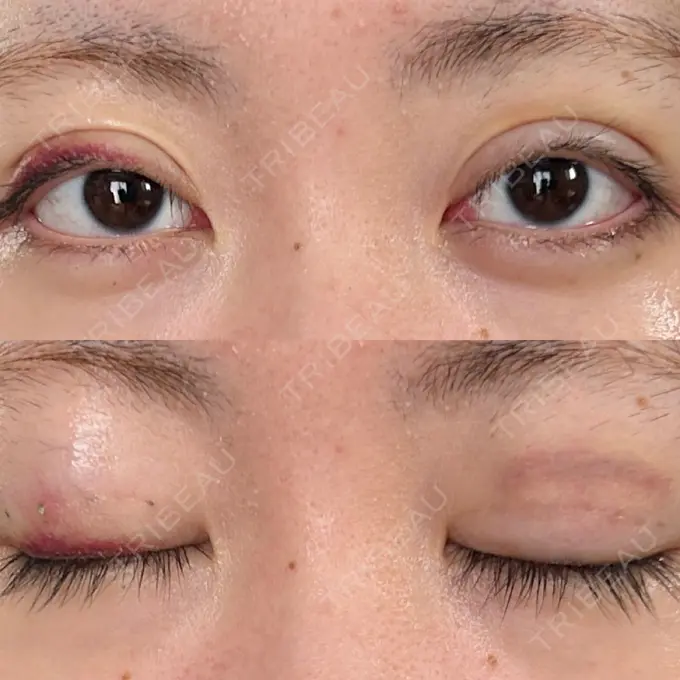 二重埋没 東京ココセランクリニック DAY 9 メイン用