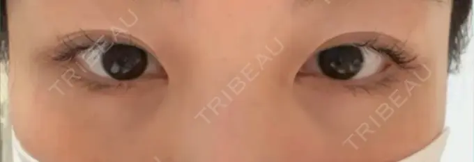 クマ治療 ROOTS Clinic DAY 5 メイン用