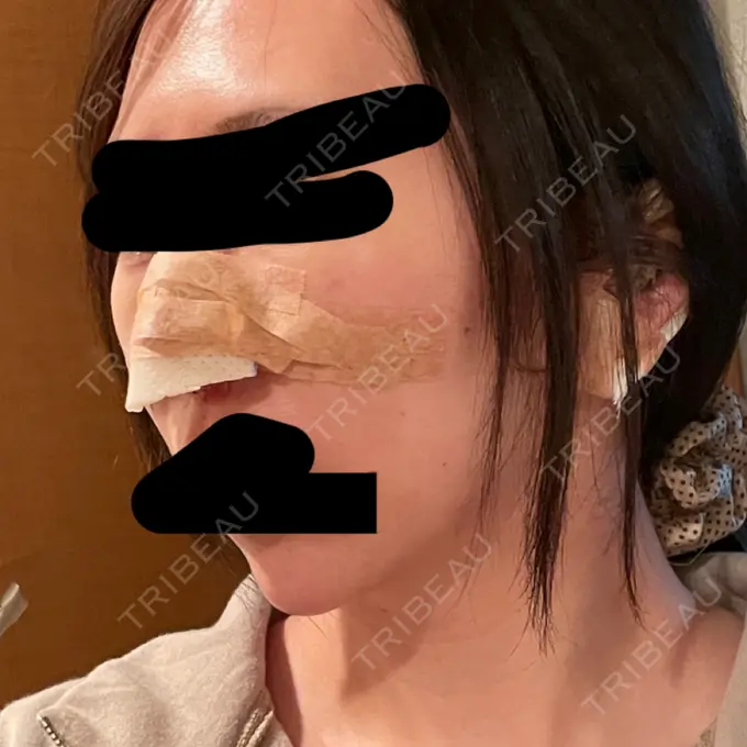 鼻尖形成（切開） / 軟骨移植 / 鼻柱下降・鼻唇角形成（猫手術） eクリニック 金沢本院 DAY 1 メイン用