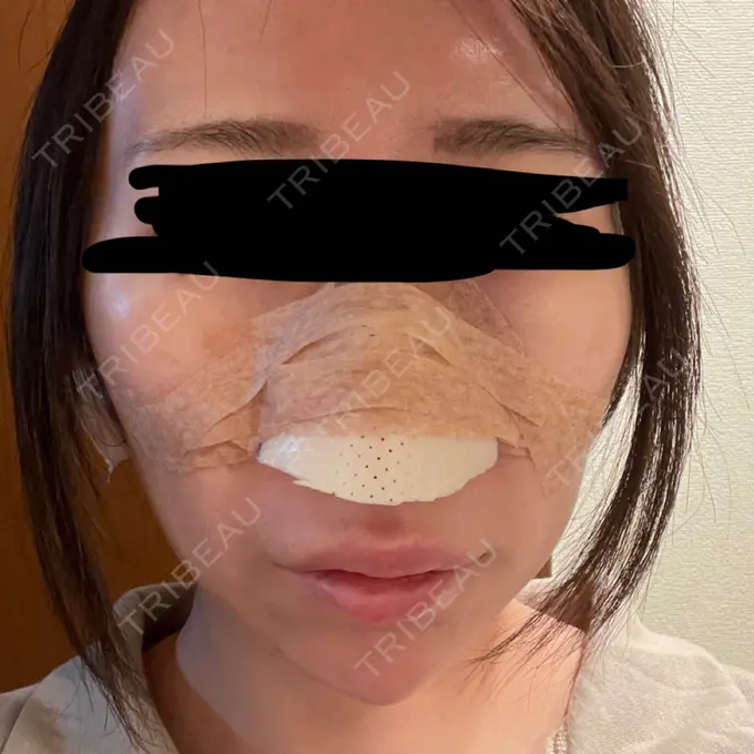 鼻尖形成（切開） / 軟骨移植 / 鼻柱下降・鼻唇角形成（猫手術） eクリニック 金沢本院 DAY 1 メイン用