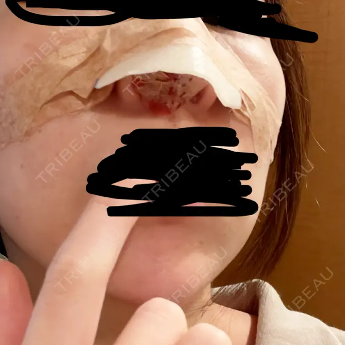 鼻尖形成（切開） / 軟骨移植 / 鼻柱下降・鼻唇角形成（猫手術） eクリニック 金沢本院 DAY 1 メイン用