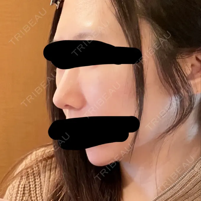 鼻尖形成（切開） / 軟骨移植 / 鼻柱下降・鼻唇角形成（猫手術） eクリニック 金沢本院 DAY 11 メイン用