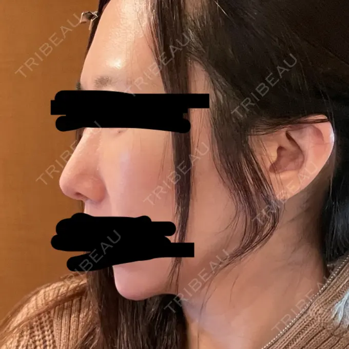 鼻尖形成（切開） / 軟骨移植 / 鼻柱下降・鼻唇角形成（猫手術） eクリニック 金沢本院 DAY 11 メイン用