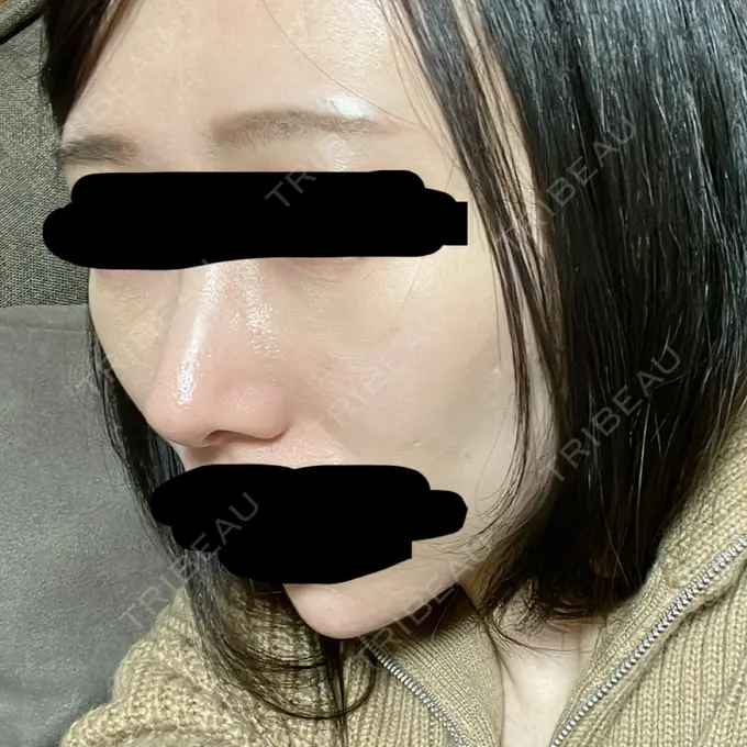 鼻尖形成（切開） / 軟骨移植 / 鼻柱下降・鼻唇角形成（猫手術） eクリニック 金沢本院 DAY 32 メイン用