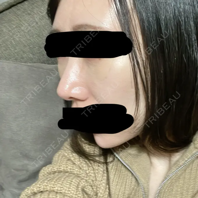 鼻尖形成（切開） / 軟骨移植 / 鼻柱下降・鼻唇角形成（猫手術） eクリニック 金沢本院 DAY 32 メイン用