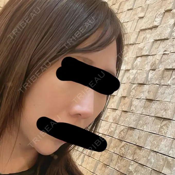 鼻尖形成（切開） / 軟骨移植 / 鼻柱下降・鼻唇角形成（猫手術） eクリニック 金沢本院 DAY 77 メイン用