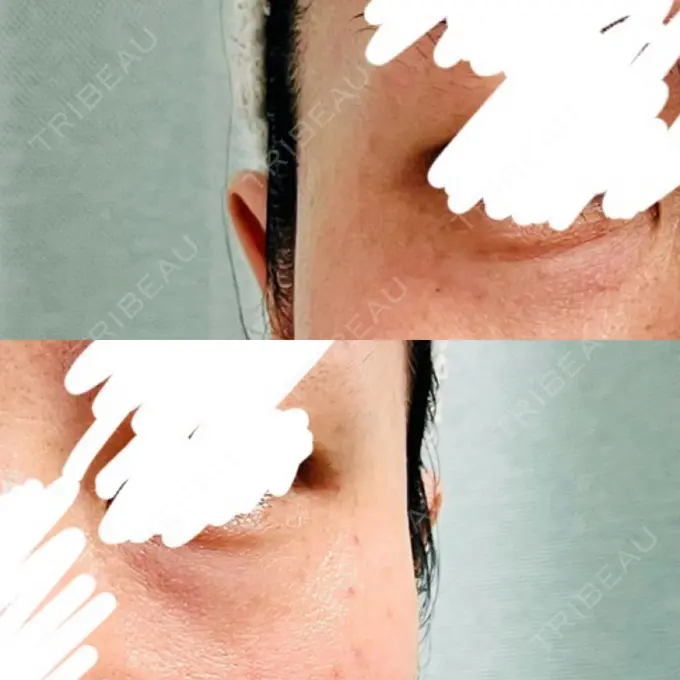 ボトックス（目尻） / その他（目元） 湘南美容クリニック 立川院 DAY 4 メイン用