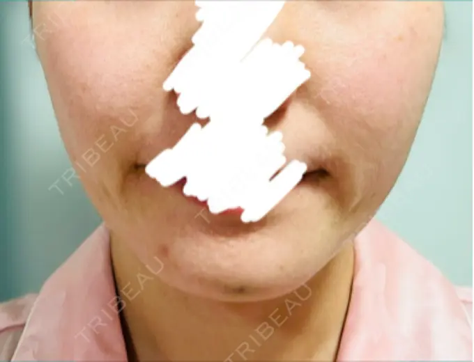 ボトックス（あご） / ボトックス（エラ・小顔） 湘南美容クリニック 立川院 DAY 3 メイン用