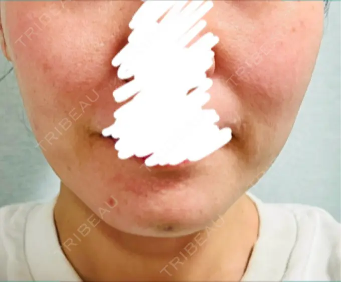 ボトックス（あご） / ボトックス（エラ・小顔） 湘南美容クリニック 立川院 DAY 4 メイン用