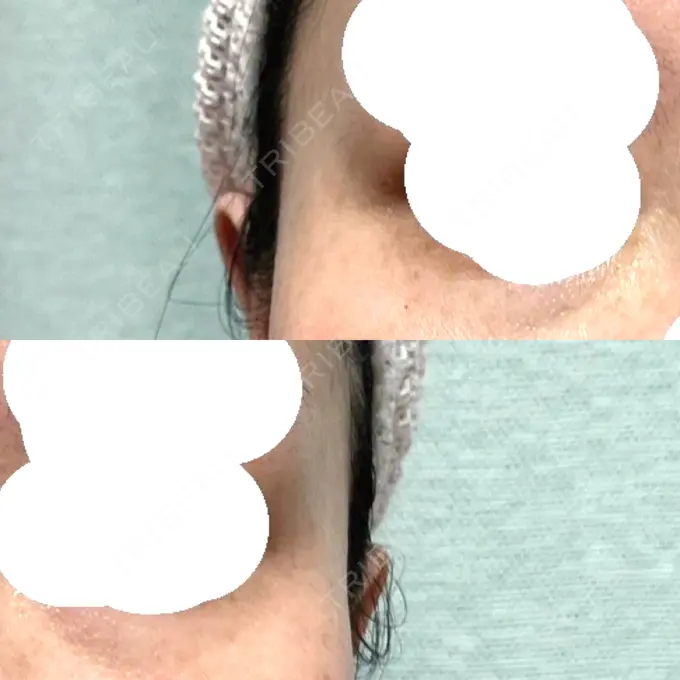 ボトックス（目尻） / その他（目元） 湘南美容クリニック 立川院 DAY 5 メイン用