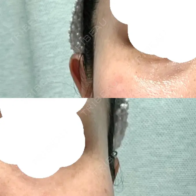 ボトックス（目尻） / その他（目元） 湘南美容クリニック 立川院 DAY 7 メイン用