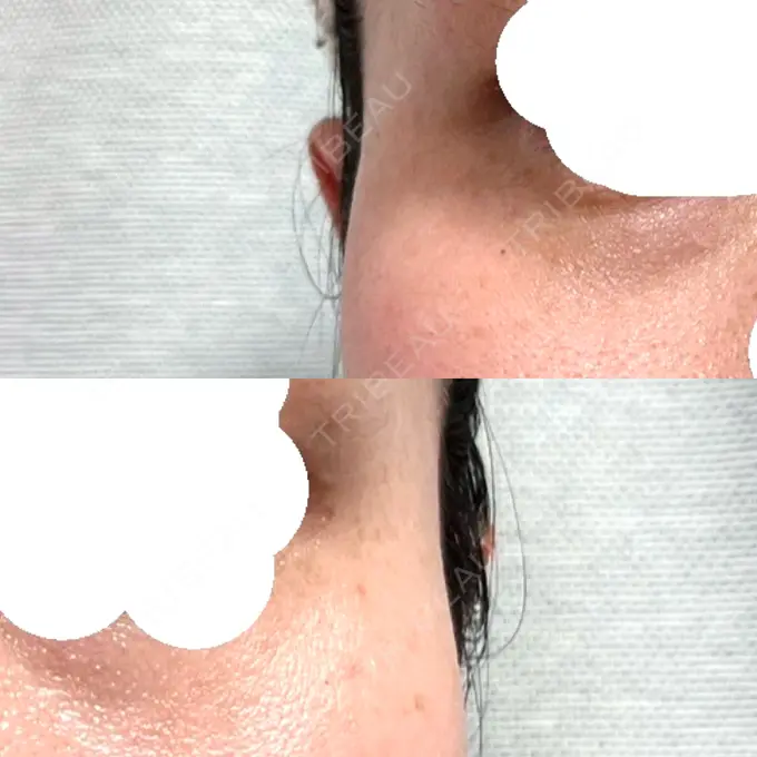 ボトックス（目尻） / その他（目元） 湘南美容クリニック 立川院 DAY 10 メイン用