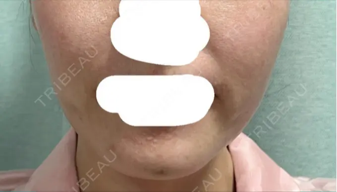 ボトックス（あご） / ボトックス（エラ・小顔） 湘南美容クリニック 立川院 DAY 5 メイン用