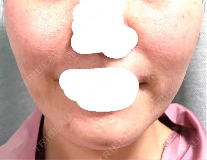 ボトックス（あご） / ボトックス（エラ・小顔） 湘南美容クリニック 立川院 DAY 6 メイン用