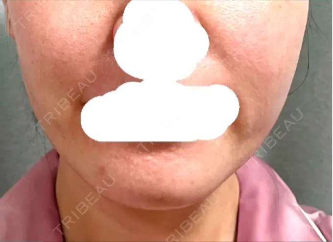 ボトックス（あご） / ボトックス（エラ・小顔） 湘南美容クリニック 立川院 DAY 7 メイン用