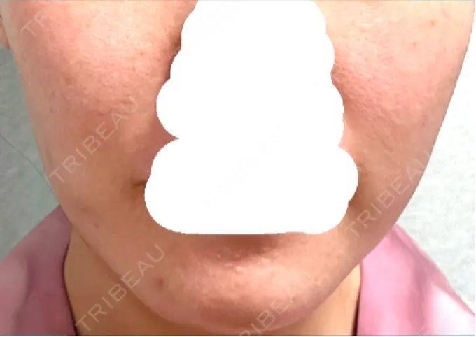 ボトックス（あご） / ボトックス（エラ・小顔） 湘南美容クリニック 立川院 DAY 8 メイン用