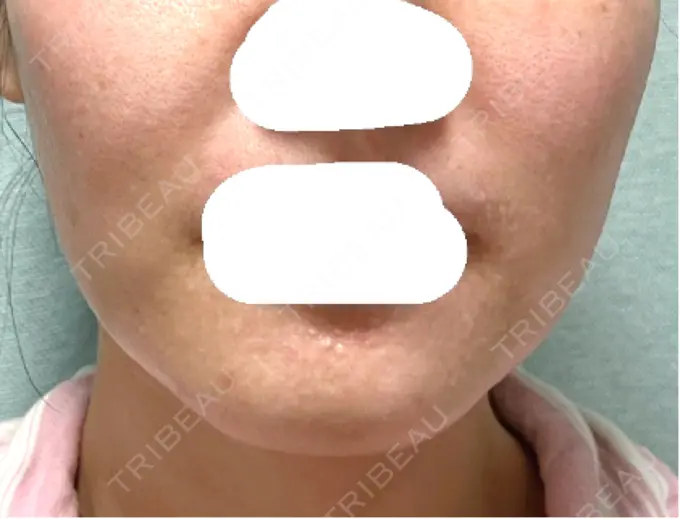 ボトックス（あご） / ボトックス（エラ・小顔） 湘南美容クリニック 立川院 DAY 9 メイン用