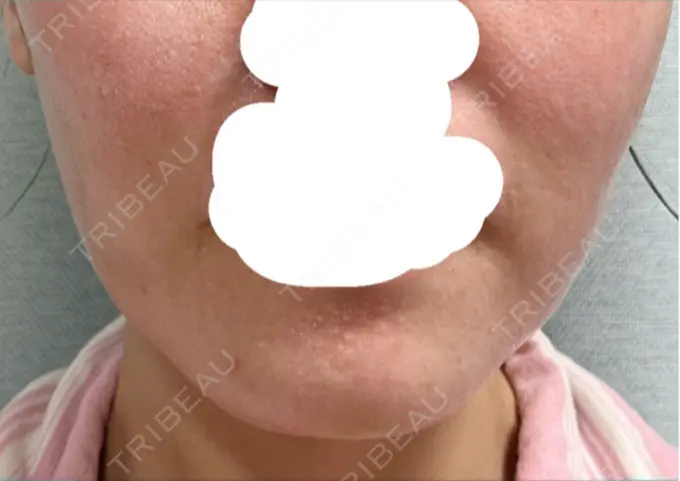 ボトックス（あご） / ボトックス（エラ・小顔） 湘南美容クリニック 立川院 DAY 10 メイン用