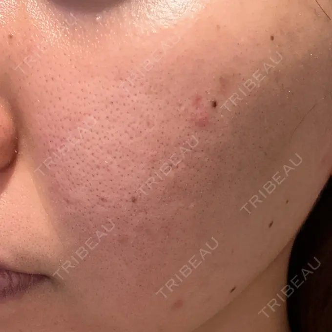 美肌レーザー / シミ取りレーザー / フラクショナルレーザー（毛穴・ニキビ跡） / YAGレーザー / 赤み除去レーザー / ピコフラクショナルレーザー（毛穴・ニキビ跡） AI Beauty Clinic （エーアイ美容クリニック） DAY 3 メイン用