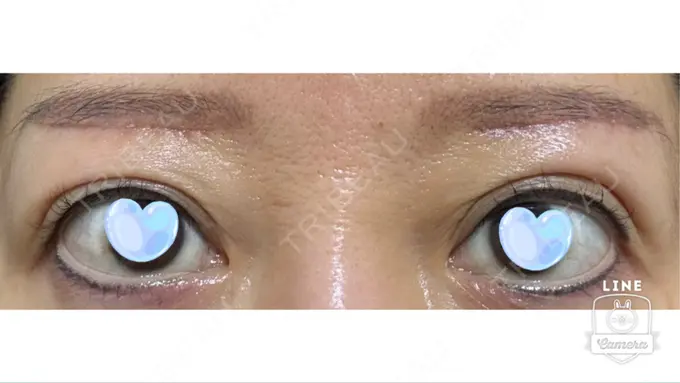 眉下切開 ルーチェクリニック 銀座院 DAY 22 メイン用