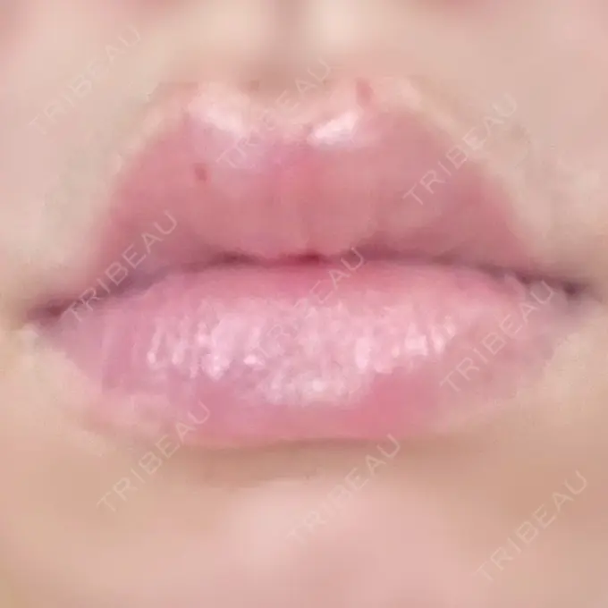 ヒアルロン酸注入（唇） ルラ美容クリニック 名古屋栄院 / ルラスキンクリニック 名古屋栄院 DAY 2 メイン用