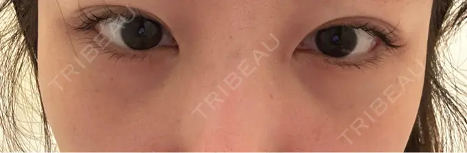 クマ治療 ROOTS Clinic DAY 6 メイン用