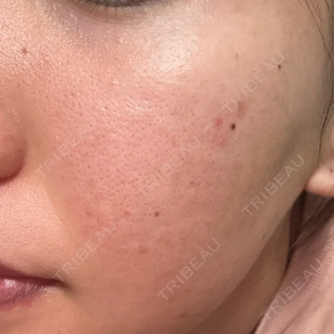 美肌レーザー / シミ取りレーザー / フラクショナルレーザー（毛穴・ニキビ跡） / YAGレーザー / 赤み除去レーザー / ピコフラクショナルレーザー（毛穴・ニキビ跡） AI Beauty Clinic （エーアイ美容クリニック） DAY 4 メイン用