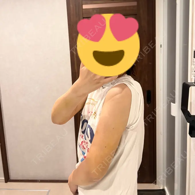 脂肪吸引（二の腕） アムルーズ美容外科クリニック 横浜院 DAY 11 メイン用